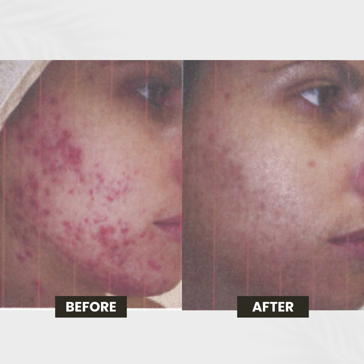 Facial Redness transformation result