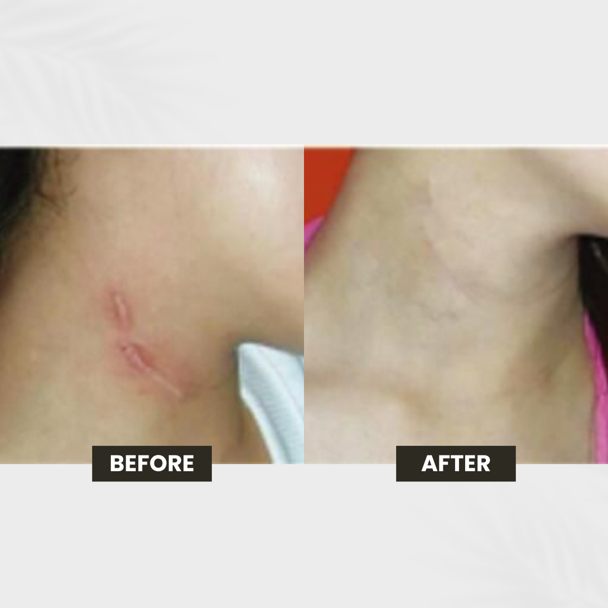 Acne Scarring transformation result
