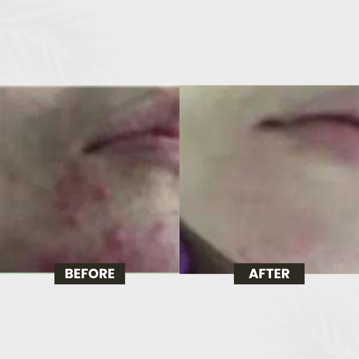 Congested Skin transformation result